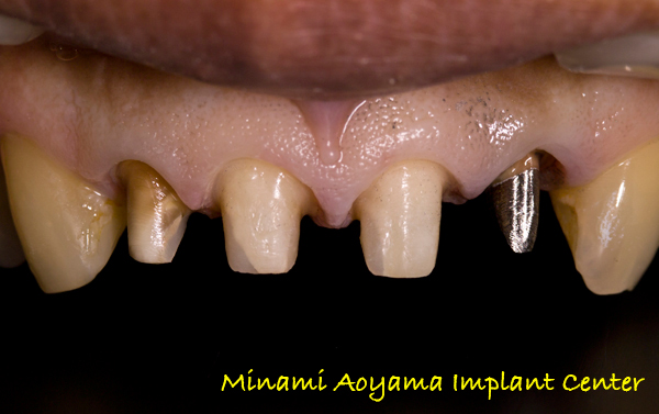 前歯メタルボンドセラミック修復ケース 症例写真3