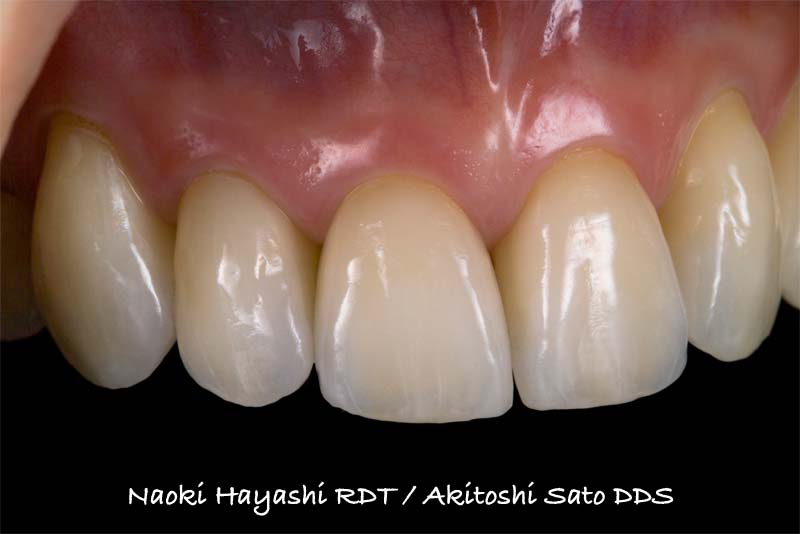 前歯ラミネートベニア修復ケース 症例写真4