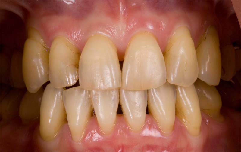 前歯ラミネートベニア修復ケース 症例写真1