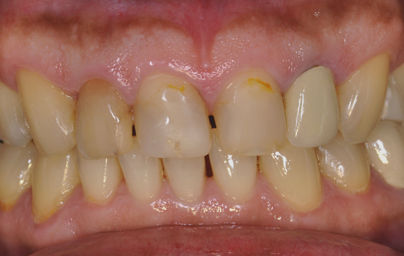 前歯メタルボンドセラミック修復ケース 症例写真2
