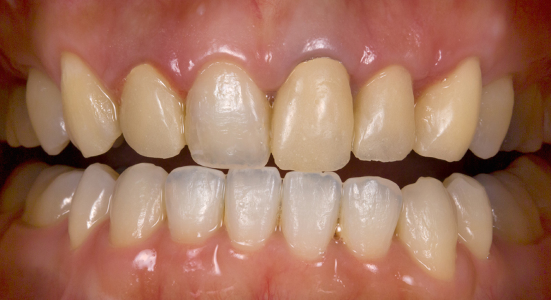 前歯セラミック修復ケース 症例写真1