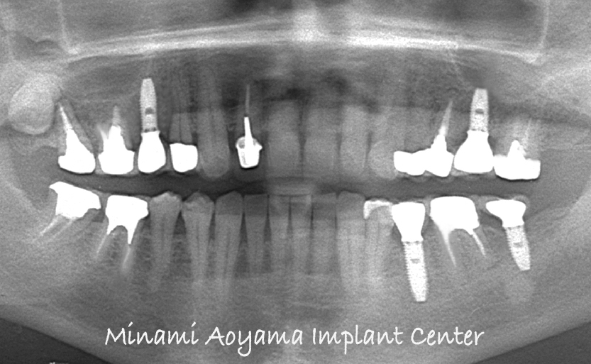 前歯を含めた全顎的インプラントセラミック修復ケース 症例写真4