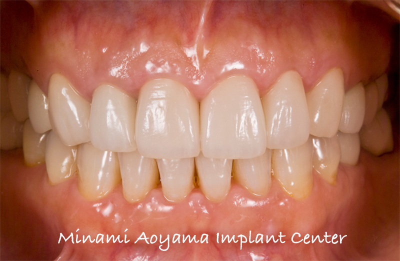 前歯を含めた全顎的インプラントセラミック修復ケース 症例写真3