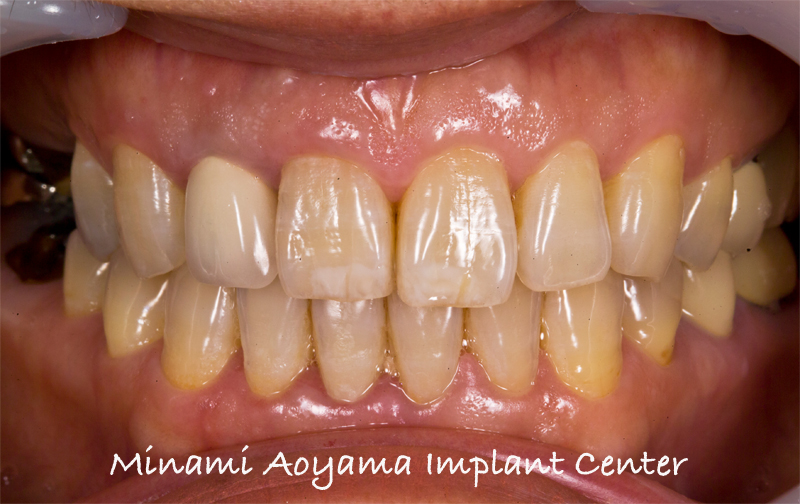 前歯を含めた全顎的インプラントセラミック修復ケース 症例写真1