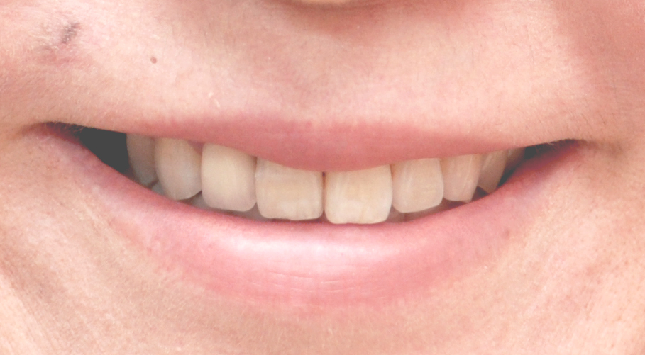 前歯を含めた全顎的インプラントセラミック修復ケース 症例写真5
