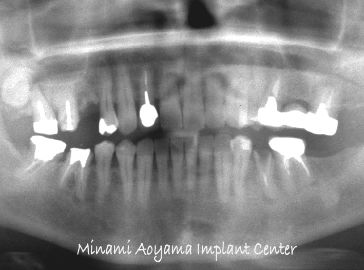 前歯を含めた全顎的インプラントセラミック修復ケース 症例写真2