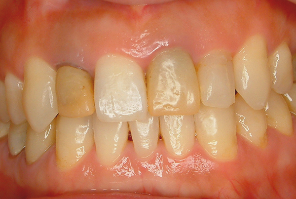 前歯セラミック修復ケース 症例写真2