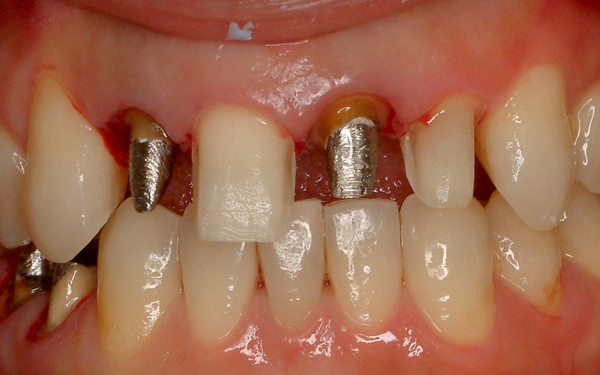 前歯セラミック修復ケース 症例写真3