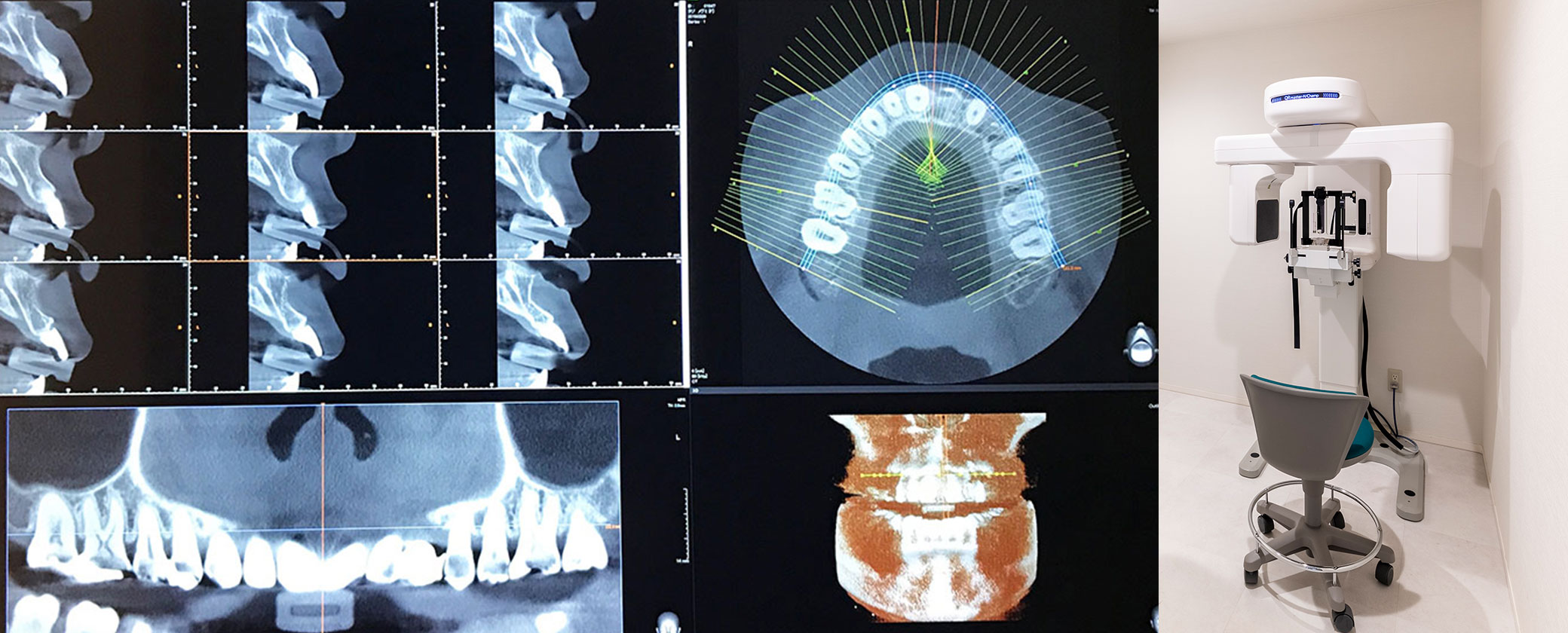 新型の歯科用CT撮影機器（コンピューター断層撮影装置）完備
						 