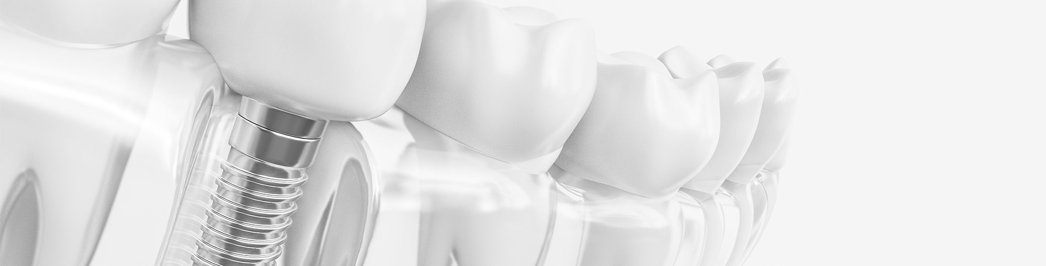 インプラント治療費（Dental Implants）
