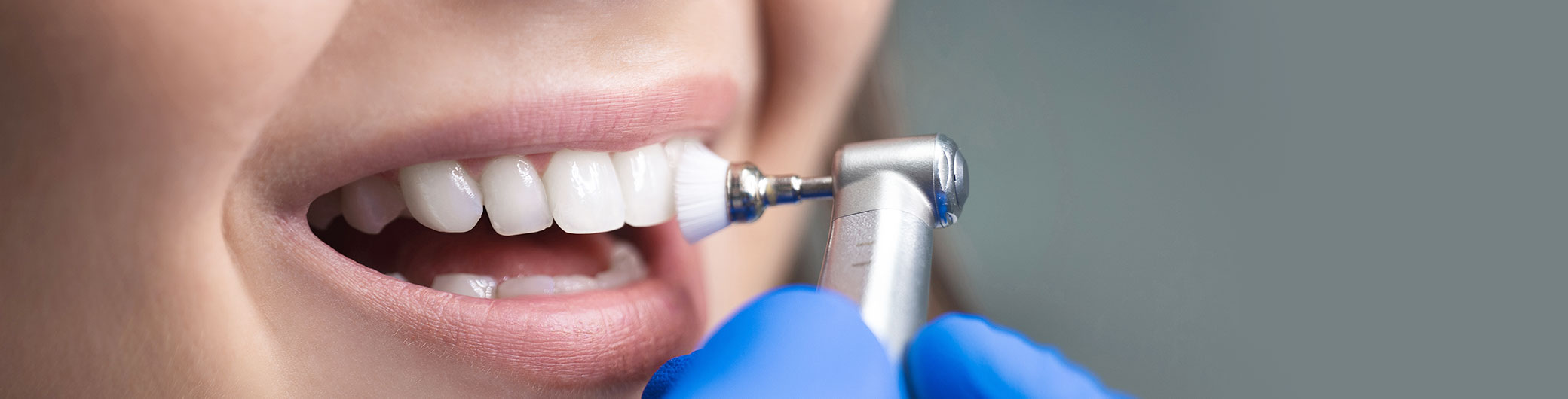 歯のクリーニング（Regular Teeth Cleaning）
