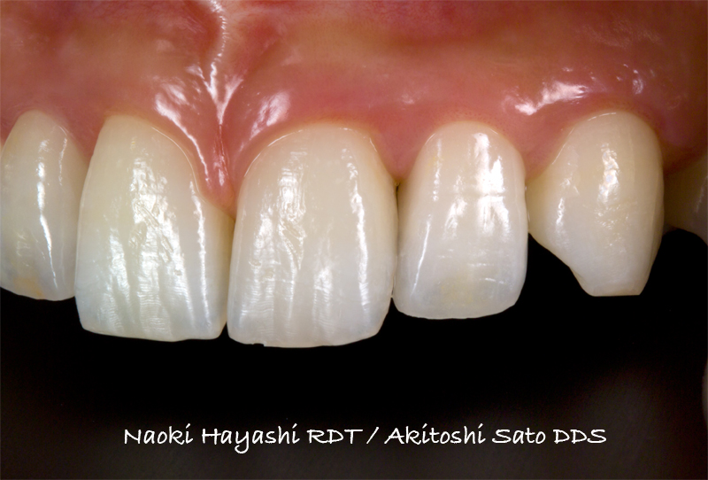 上顎左右側切歯　先天欠損症例 症例写真7