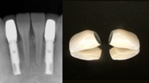 下顎前歯先天欠損症例 症例写真4