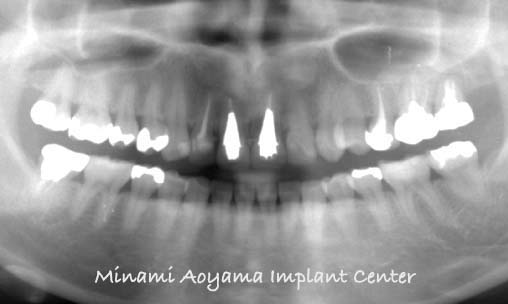 インプラントとセラミック修復による上顎前歯症例 症例写真3