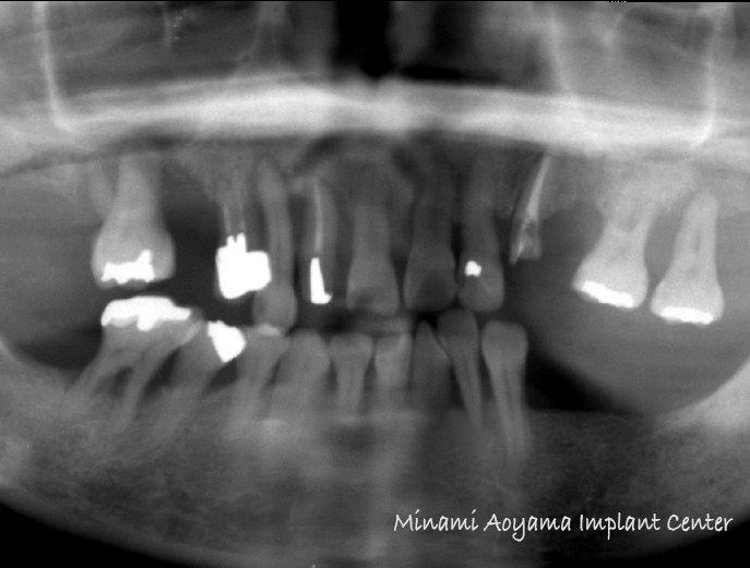 オールオンフォー（上顎全歯抜歯後、インプラント義歯を即日装着） 症例写真3
