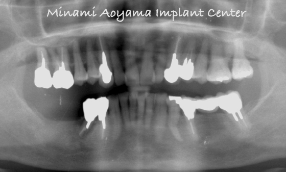 奥歯にインプラント治療を行った症例1 症例写真2