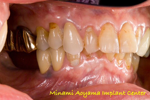 奥歯にインプラント治療を行った症例1 症例写真6