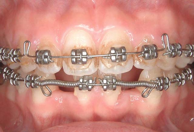 下顎前歯先天欠損症例 症例写真1