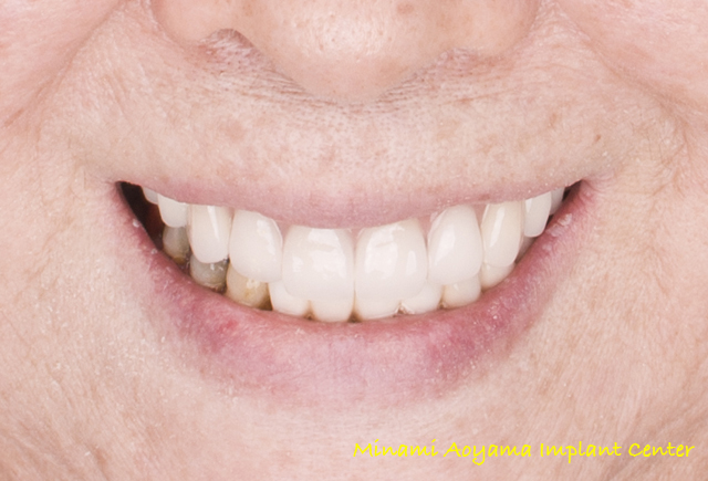 インプラントによる全顎的な審美と機能の改善例1 症例写真6