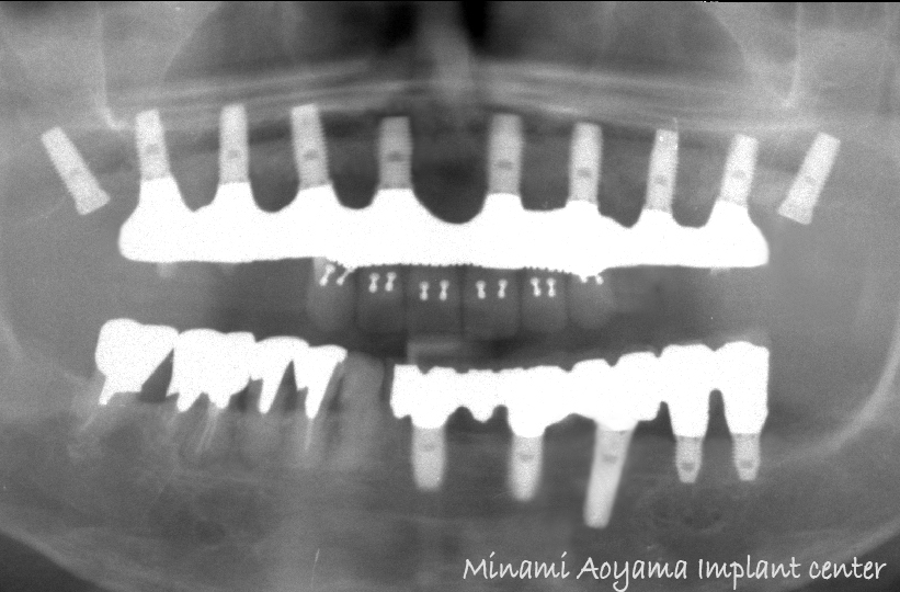 インプラントによる全顎的な審美と機能の改善例1 症例写真10