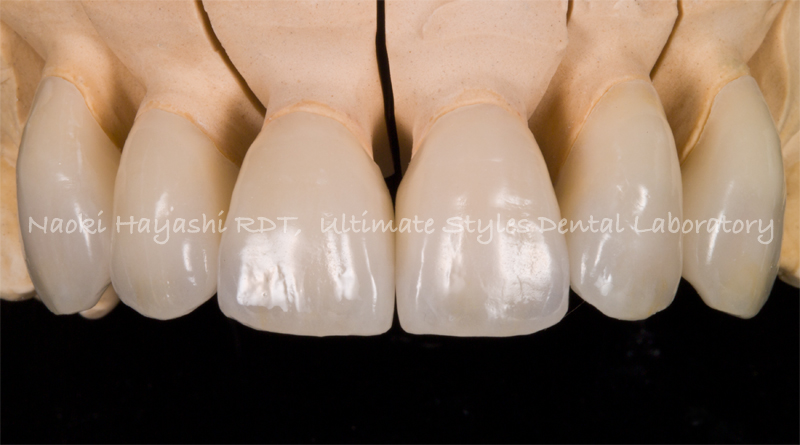 前歯ラミネートベニア修復ケース 症例写真2