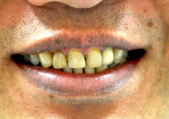前歯メタルボンドセラミック修復ケース 症例写真1