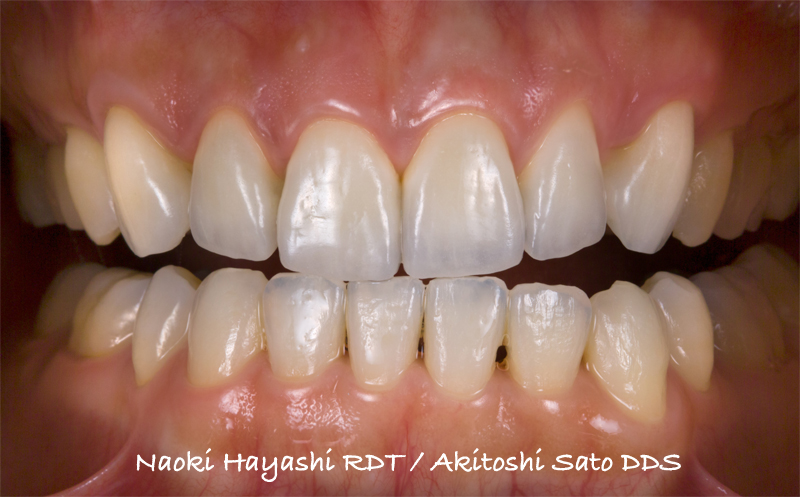 前歯セラミック修復ケース 症例写真3