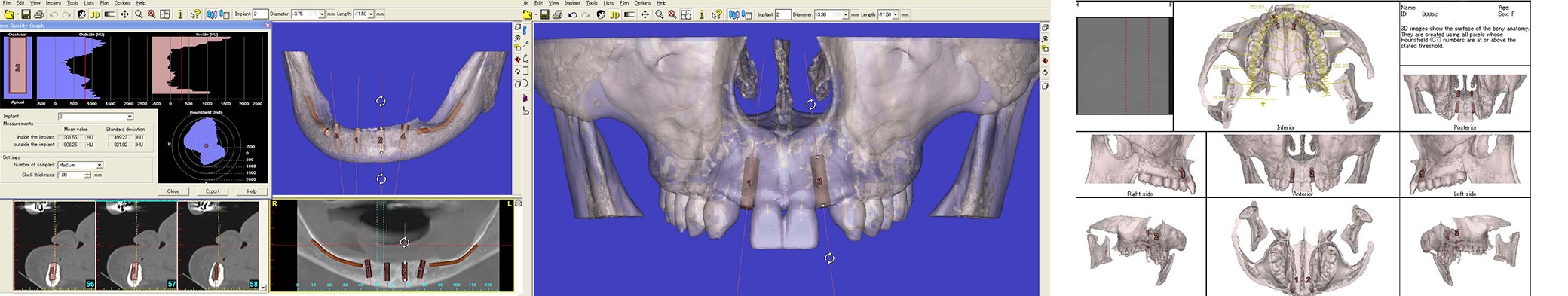 3次元CT画像解析/シミュレーションソフト、DTX Studio Implant、およびSim/Plantの導入